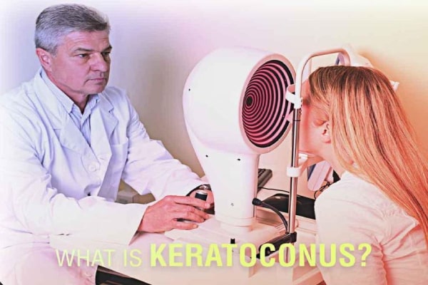 What Is Keratoconus What Is Keratoconus