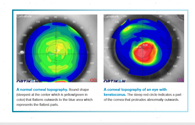 a keratoconus myopia hogyan lehet javítani a látás táplálkozását