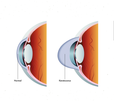 a keratoconus myopia