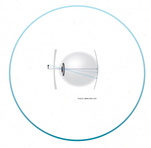 how-do-glasses-correct-myopia