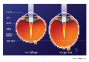 myopic eye