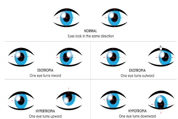 How To Fix Your Vision After Brain Surgery