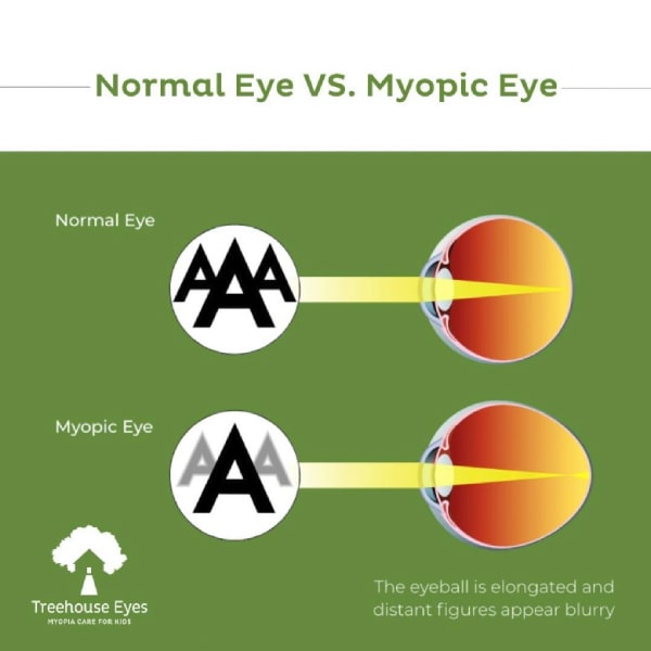 Myopia Nearsightedness A Pervasive Disease Fig 1