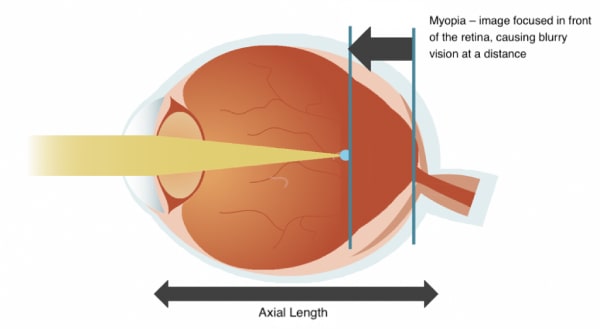 Myopia Nearsightedness A Pervasive Disease Fig 2