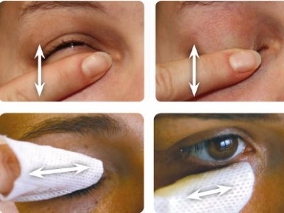 A Eyelid Cleaning Procedure Eyelid Massage To Express Waxy Meibomian Secretion B
