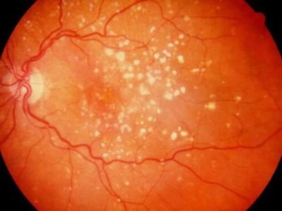 Age Related Macular Degeneration