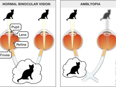 Amblyopia Med Ill En