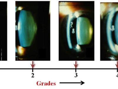Cataract Grading Scales