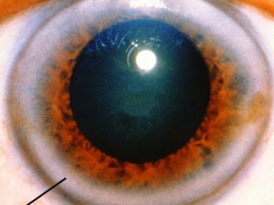 Corneal Arcus