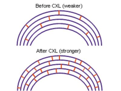 Corneal Crosslinking