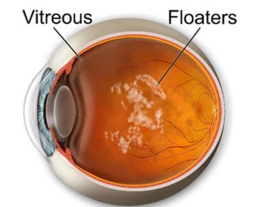 Eye Floaters