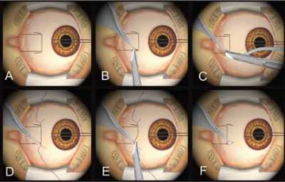 Eye Treatments