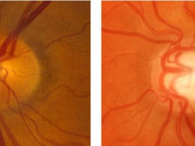 Glaucoma Optic Nerve Damage
