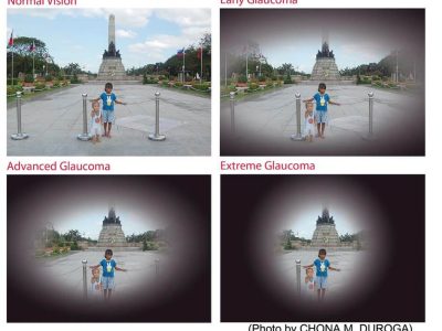 Glaucoma Stages