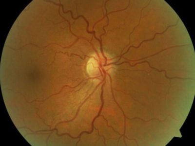 Hypertensive Retinopathy Eye Disorder