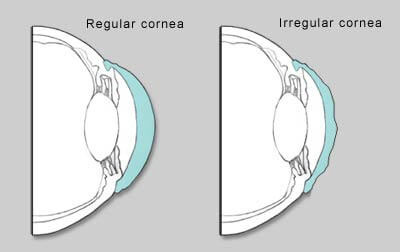 Irregular Cornea Conditions