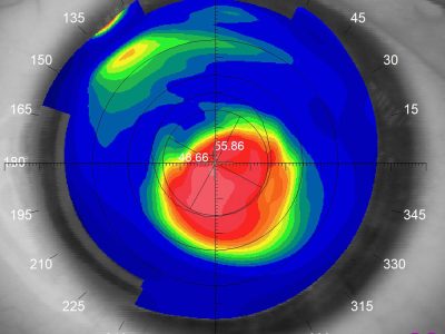 Keratoconus Corneal Topography