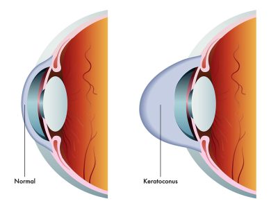 Keratoconus Illustration