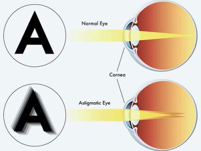 Lazy Eye Amblyopia