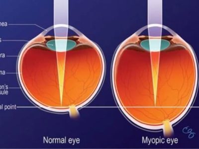 Myopic Eye