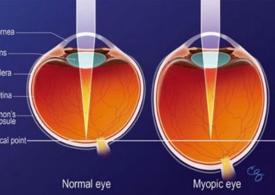 Myopic Eye