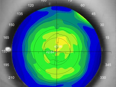 Normal Corneal Topography