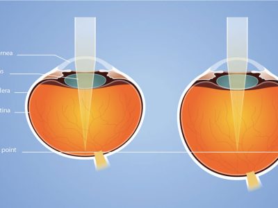 Ortho K Focal Point