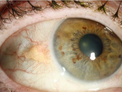 Pinguecula Eye Disorder