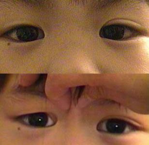 Pseudoesotropia Condition