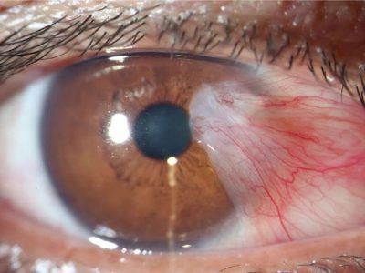 Pterygium Growth