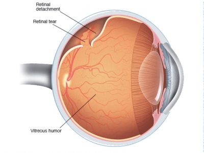 Retinal Tear Detachment