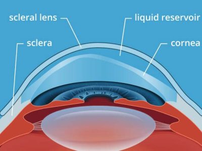Scleral Lens Diagram