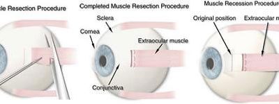 Strabismus Surgery