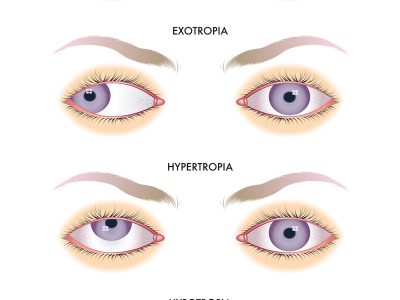 Strabismus Types