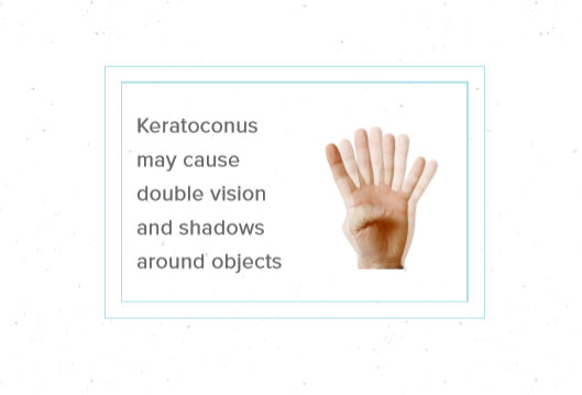 Keratoconus May Cause Double Vision