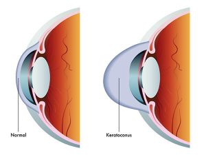 Symptoms Of Keratoconus