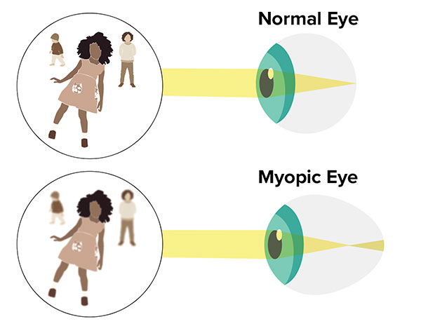 What Is Myopia