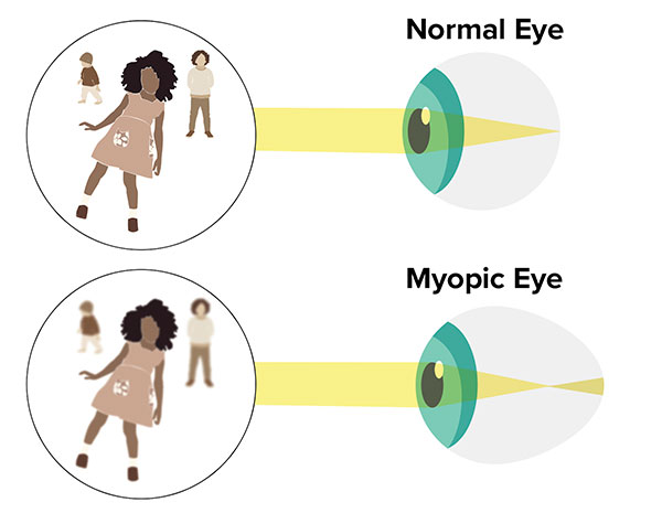 What Is Myopia What Is Myopia
